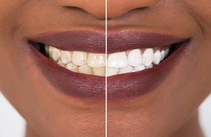 Patient's smile before and after teeth whitening