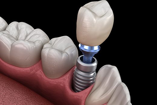 Digital image of a dental implant in Lynchburg residing in the bottom arch of teeth