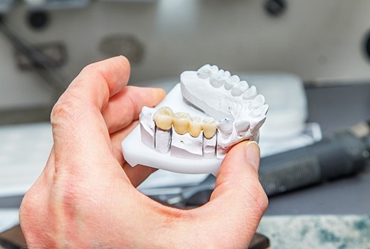 Dental bridge in Lynchburg on clay model