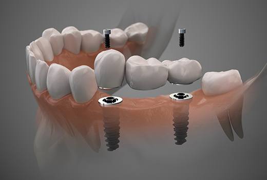 Dental implant bridge in Lynchburg