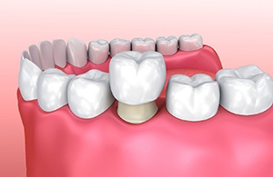 A single dental crown