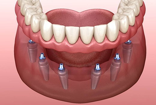 Digital illustration of implant dentures