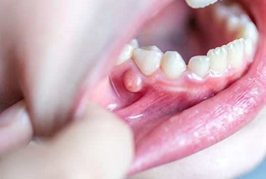 A person pulling their lower lip out to expose an abscess growing in the lower gums
