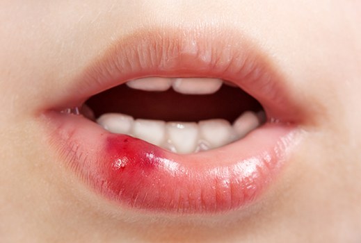 An up-close image of a bottom lip that is red and damaged