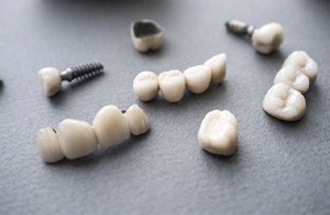 A series of implant-retained restorations.