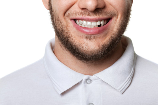 A man missing a tooth