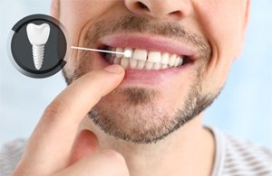 A man showing off his dental implant