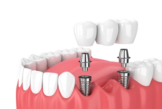 A diagram of an implant-retained bridge.