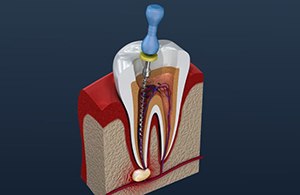 Dental forceps holding extracted tooth