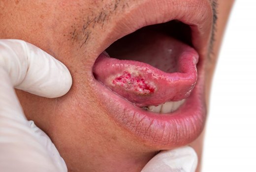 Close up of a tongue lump