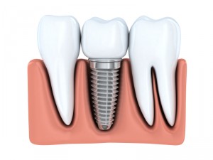 Learn more about the benefits of dental implants in Lynchburg and how to care for them.