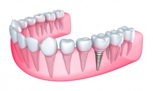 side view of dental implant 