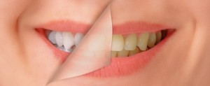 If commercials have convinced you that at-home whitening treatments are as great as working with your professional cosmetic dentist in Lynchburg, you may be off-track. 