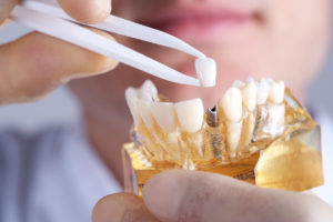 dental implants 