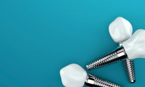 dental implants structure