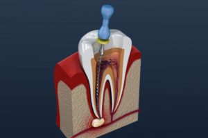 root canal diagram