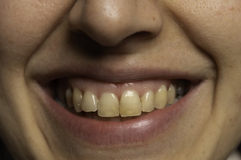 Person smiling with stained teeth