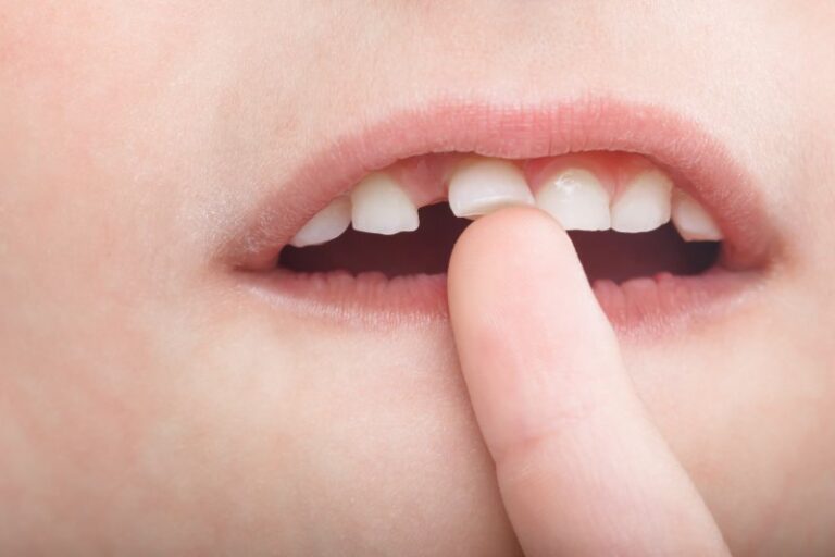 Ways to Safely Remove Your Child’s Loose Tooth | Peery & Woolwine ...