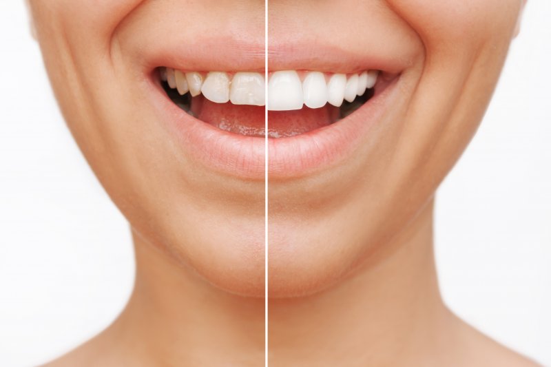 Before and after veneers