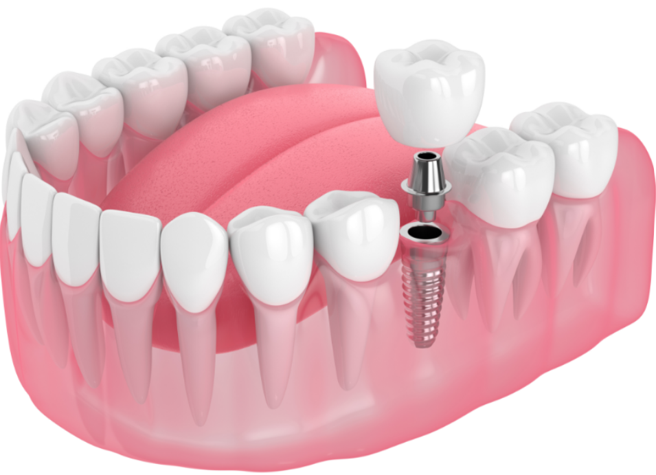 Image of a dental implant 
